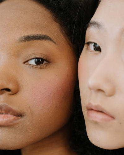 Acne Bootcamp